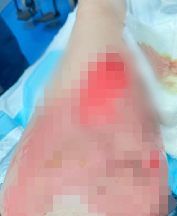 富深优配 女子乘飞机被邻座碰倒热茶致大腿二级烫伤，航司否认存过错拒绝赔偿，阿联酋航空回应